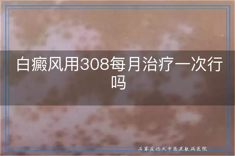 白癜风用308每月治疗一次行吗