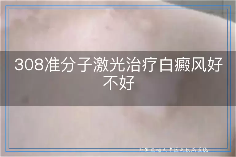 308准分子激光治疗白癜风好不好
