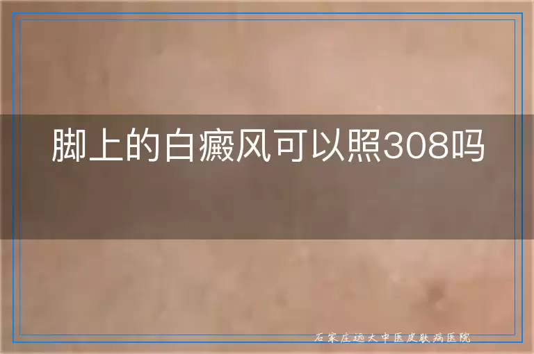 脚上的白癜风可以照308吗