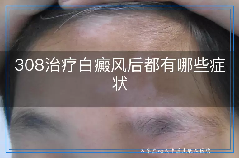 308治疗白癜风后都有哪些症状