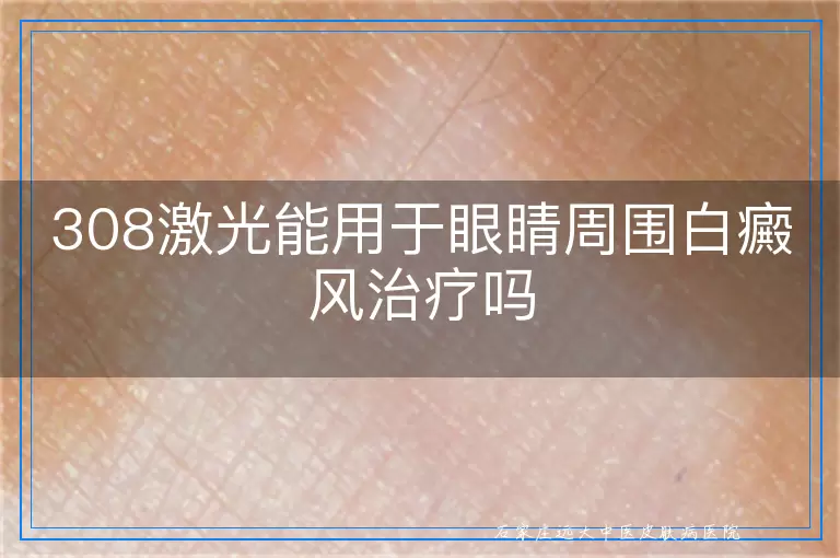 308激光能用于眼睛周围白癜风治疗吗