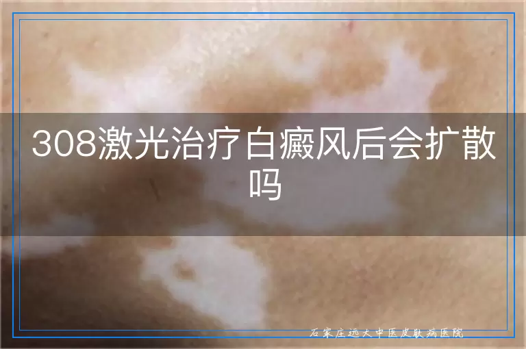 308激光治疗白癜风后会扩散吗