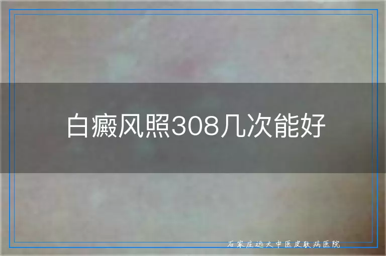 白癜风照308几次能好