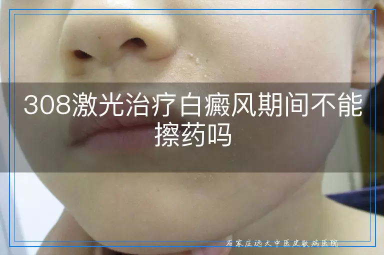 308激光治疗白癜风期间不能擦药吗