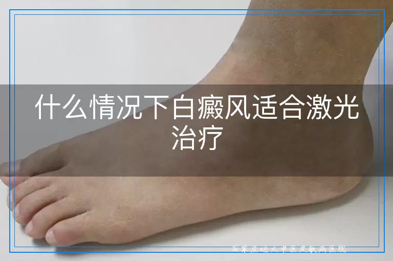 什么情况下白癜风适合激光治疗