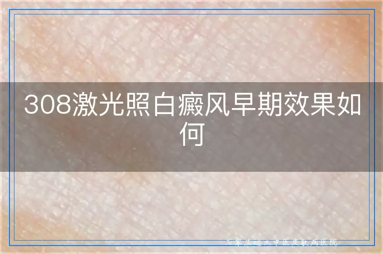 308激光照白癜风早期效果如何