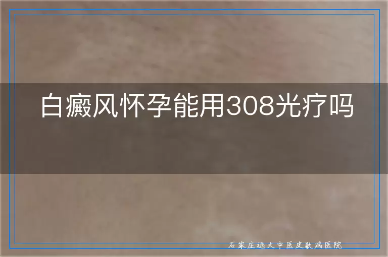 白癜风怀孕能用308光疗吗