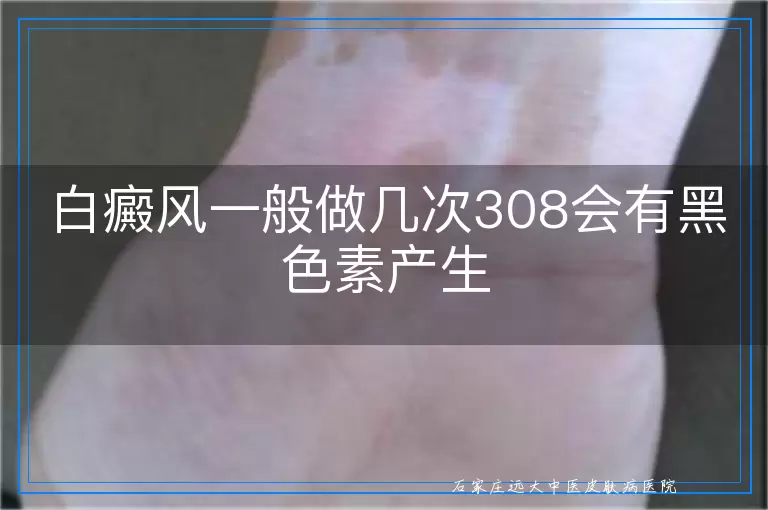 白癜风一般做几次308会有黑色素产生