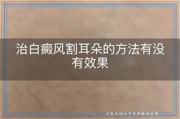 治白癜风割耳朵的方法有没有效果