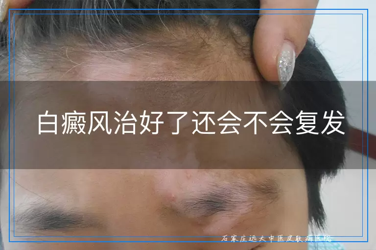 白癜风治好了还会不会复发