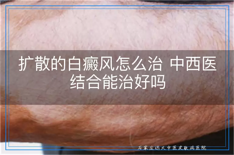 扩散的白癜风怎么治 中西医结合能治好吗