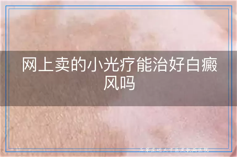 网上卖的小光疗能治好白癜风吗