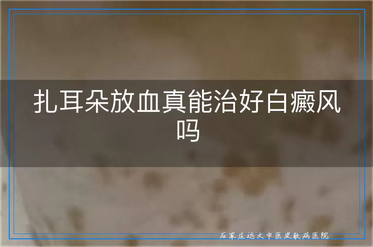 扎耳朵放血真能治好白癜风吗
