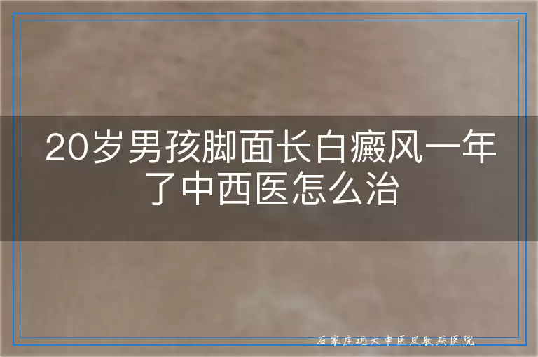 20岁男孩脚面长白癜风一年了中西医怎么治