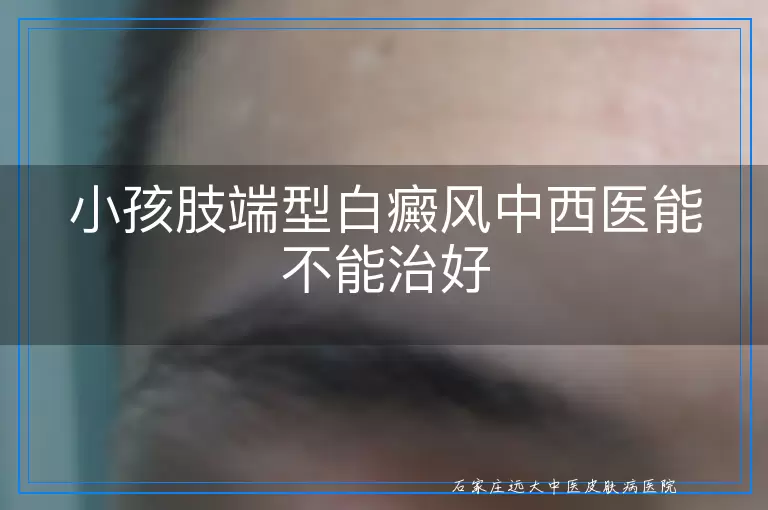 小孩肢端型白癜风中西医能不能治好
