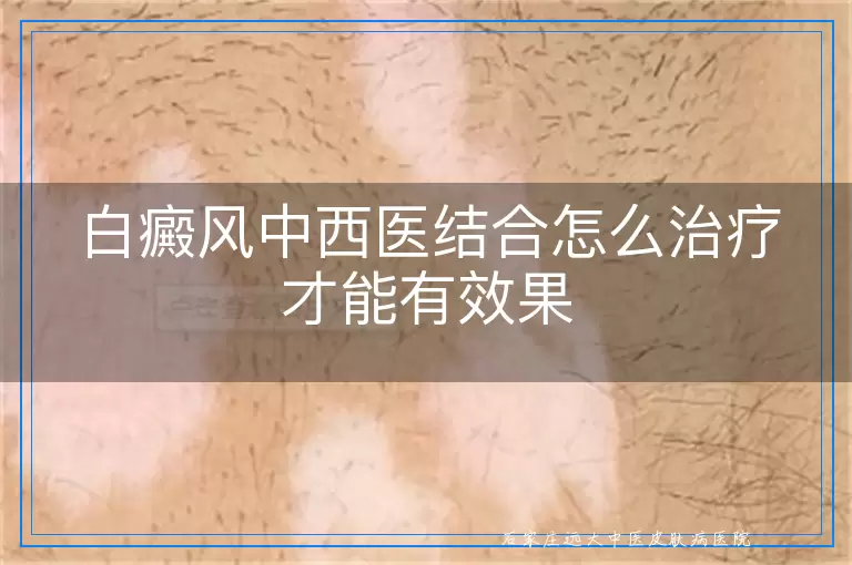 白癜风中西医结合怎么治疗才能有效果