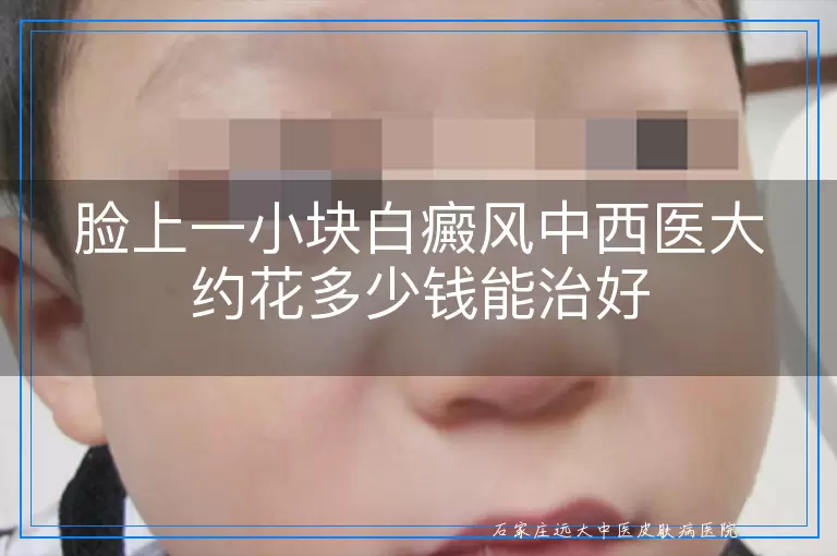 脸上一小块白癜风中西医大约花多少钱能治好