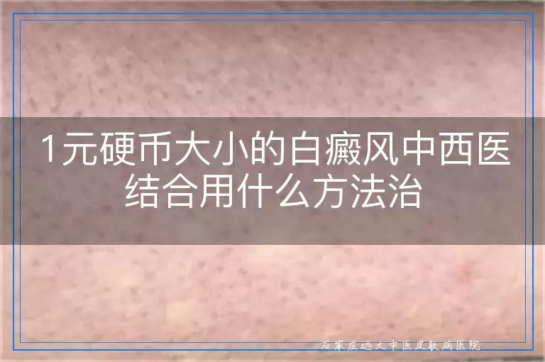 1元硬币大小的白癜风中西医结合用什么方法治