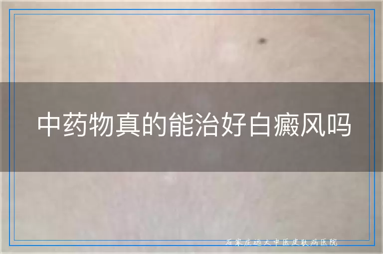 中药物真的能治好白癜风吗