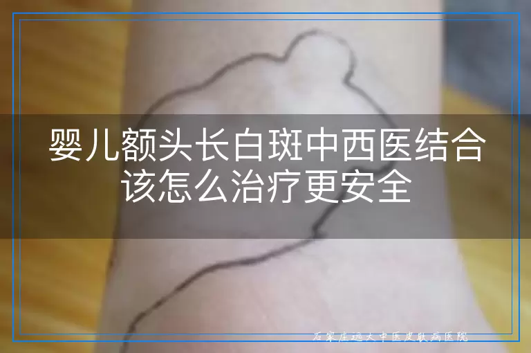 婴儿额头长白斑中西医结合该怎么治疗更安全