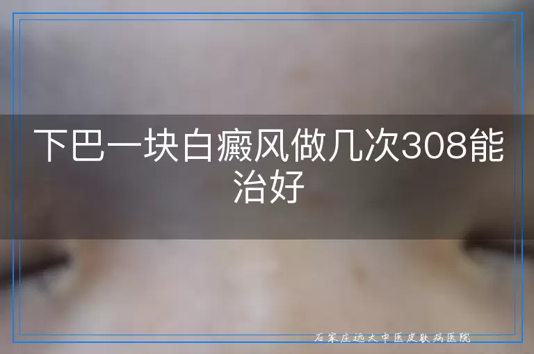 下巴一块白癜风做几次308能治好