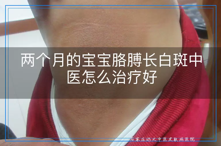 两个月的宝宝胳膊长白斑中医怎么治疗好