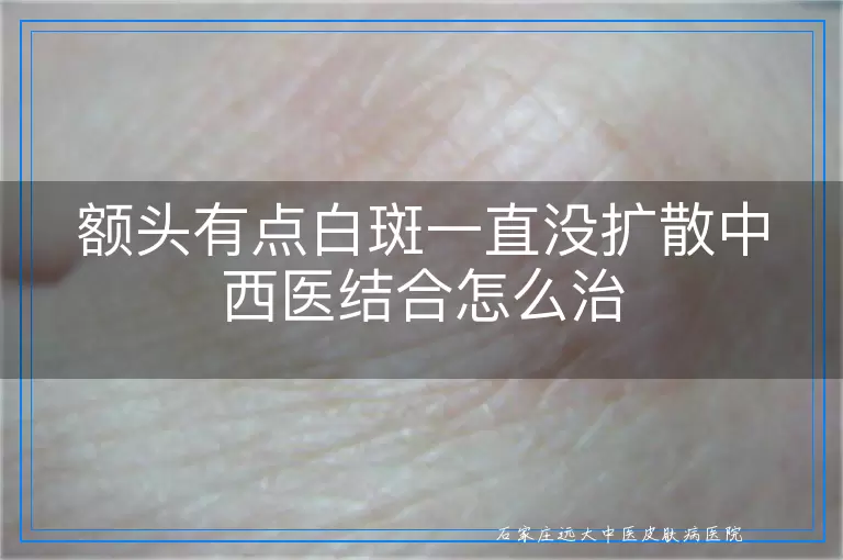额头有点白斑一直没扩散中西医结合怎么治