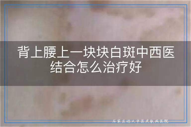 背上腰上一块块白斑中西医结合怎么治疗好