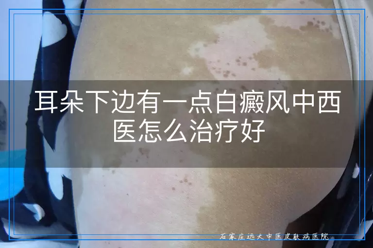 耳朵下边有一点白癜风中西医怎么治疗好