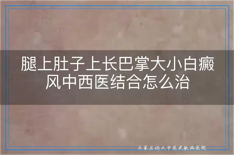 腿上肚子上长巴掌大小白癜风中西医结合怎么治