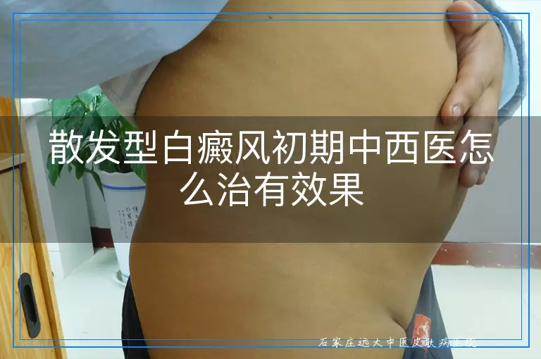 散发型白癜风初期中西医怎么治有效果