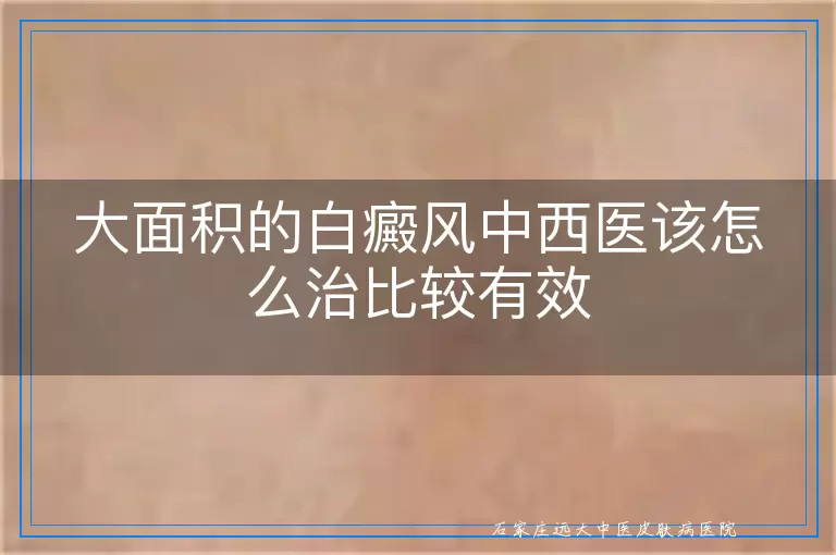 大面积的白癜风中西医该怎么治比较有效