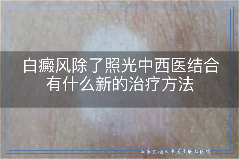 白癜风除了照光中西医结合有什么新的治疗方法