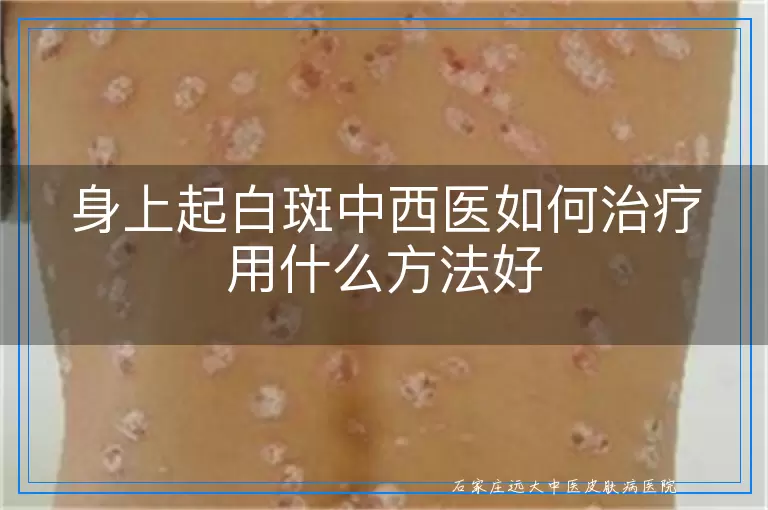 身上起白斑中西医如何治疗用什么方法好