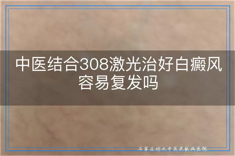 中医结合308激光治好白癜风容易复发吗