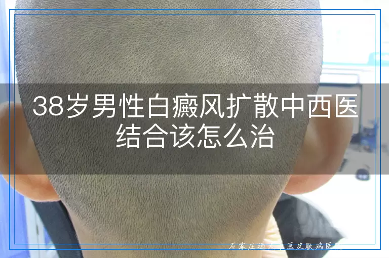 38岁男性白癜风扩散中西医结合该怎么治