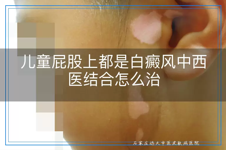 儿童屁股上都是白癜风中西医结合怎么治