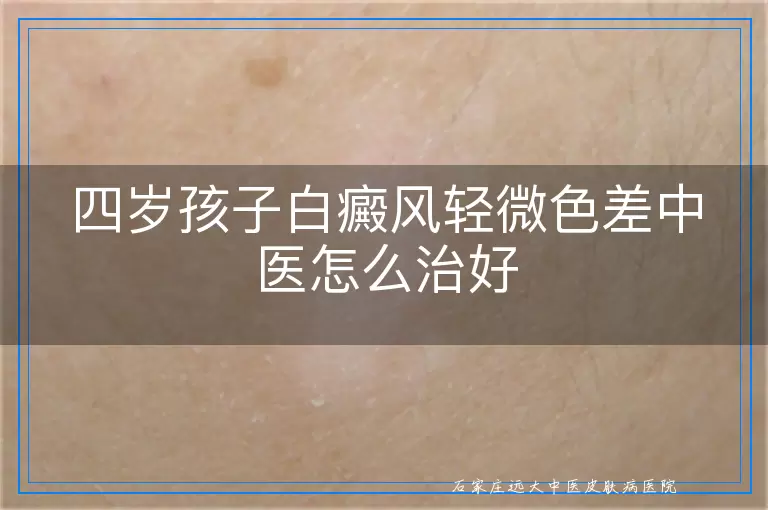 四岁孩子白癜风轻微色差中医怎么治好
