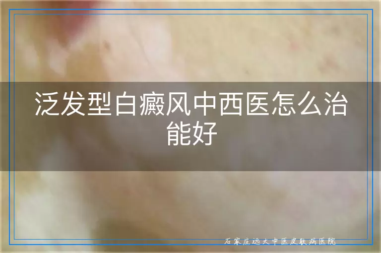 泛发型白癜风中西医怎么治能好