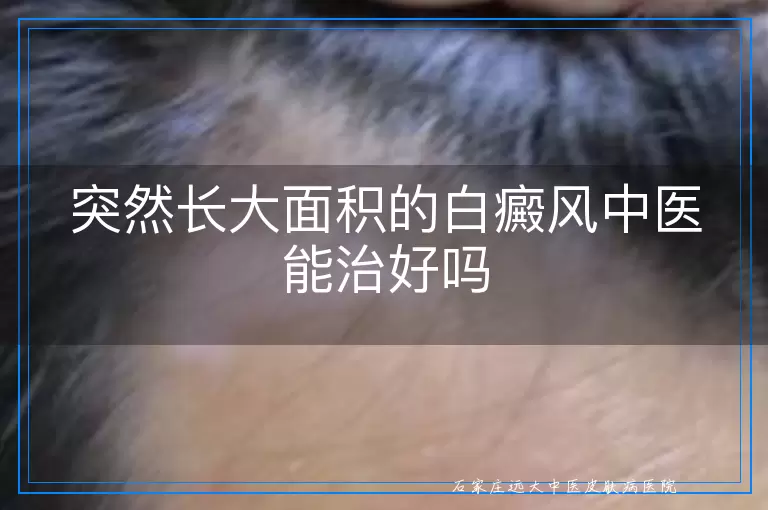 突然长大面积的白癜风中医能治好吗