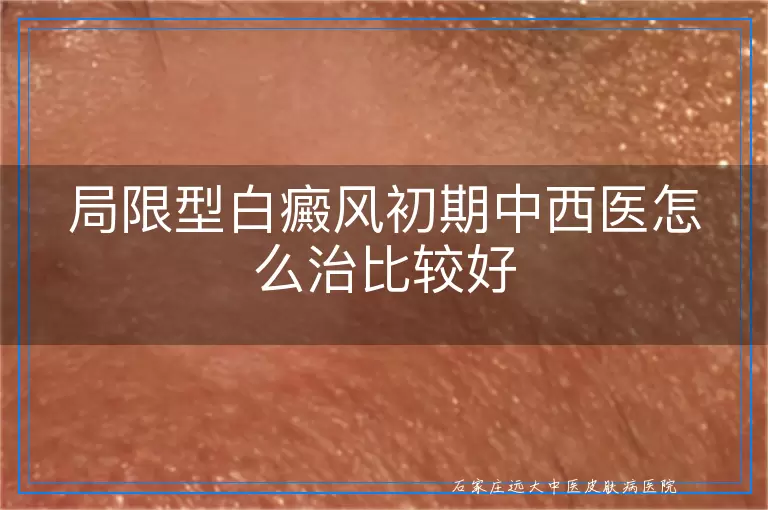 局限型白癜风初期中西医怎么治比较好