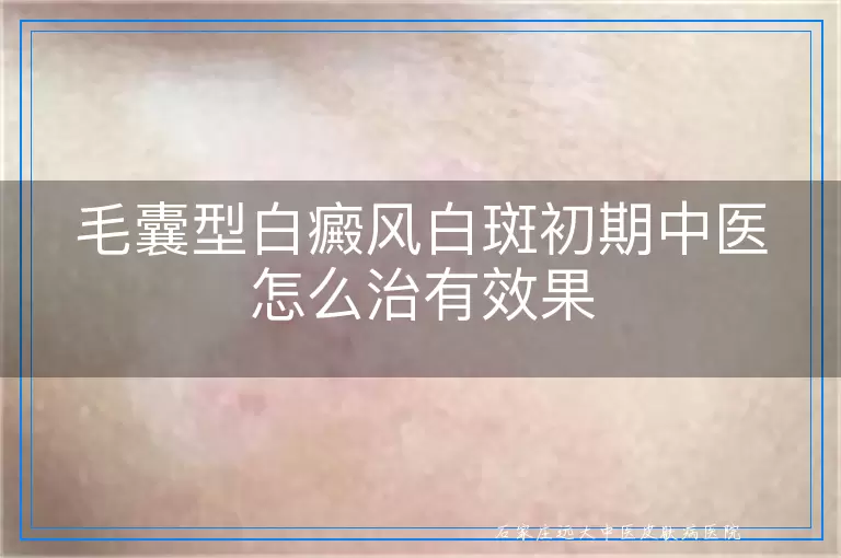 毛囊型白癜风白斑初期中医怎么治有效果