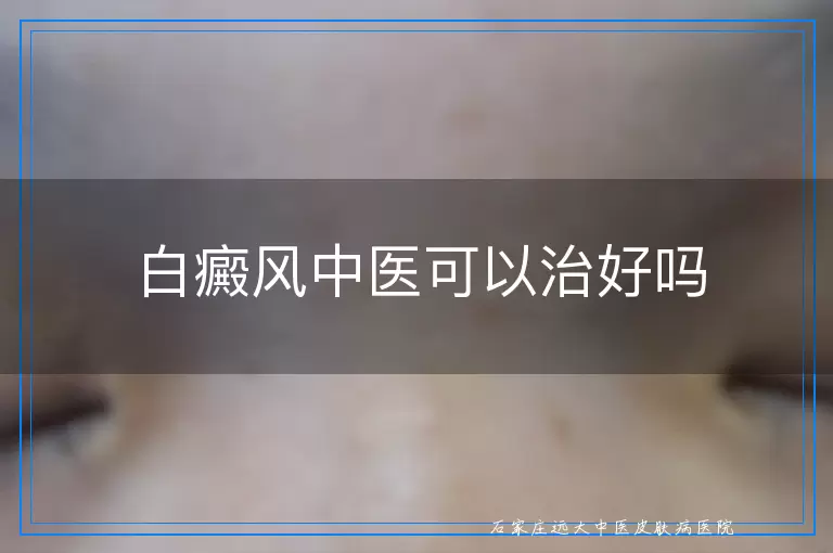 白癜风中医可以治好吗