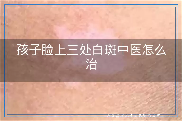 孩子脸上三处白斑中医怎么治