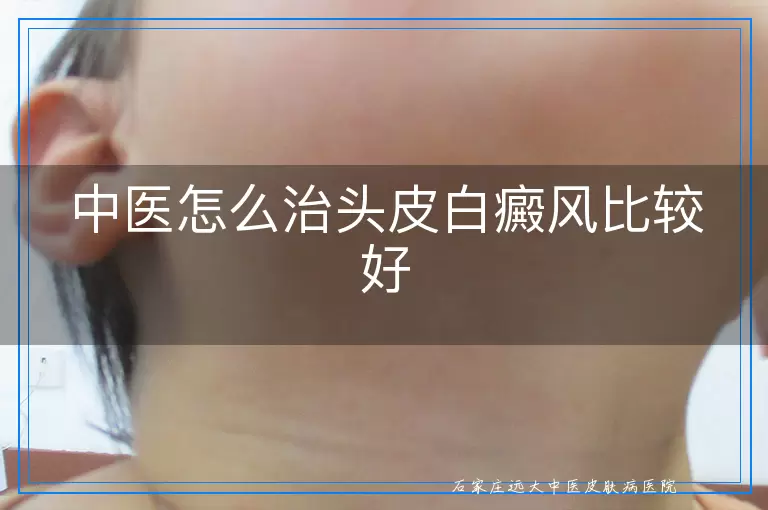 中医怎么治头皮白癜风比较好