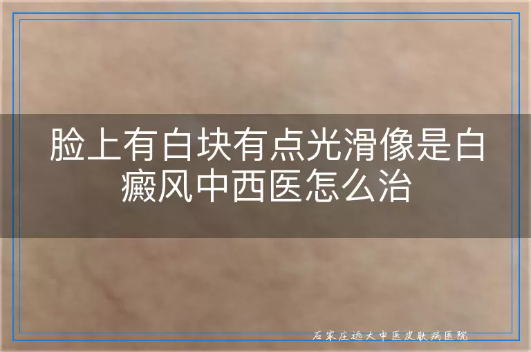脸上有白块有点光滑像是白癜风中西医怎么治