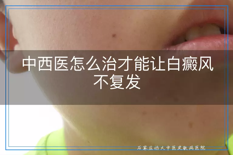 中西医怎么治才能让白癜风不复发