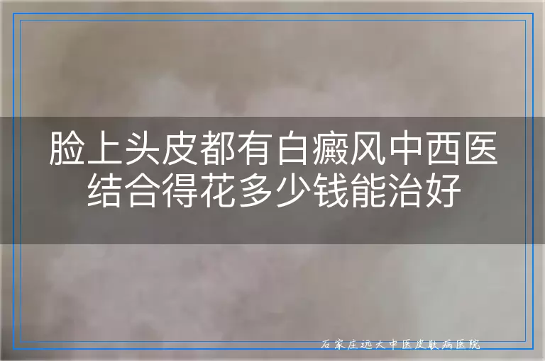 脸上头皮都有白癜风中西医结合得花多少钱能治好