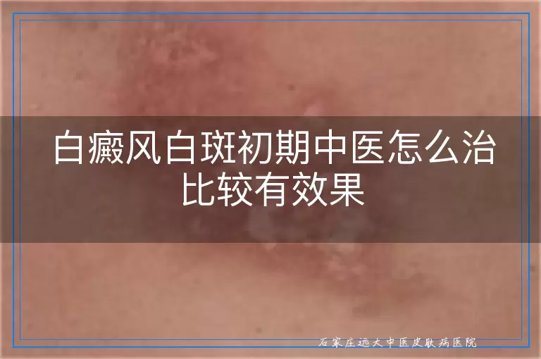 白癜风白斑初期中医怎么治比较有效果