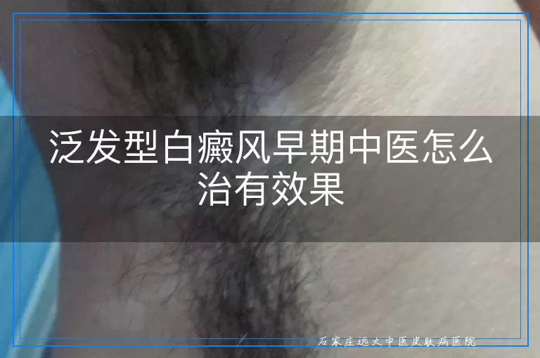 泛发型白癜风早期中医怎么治有效果